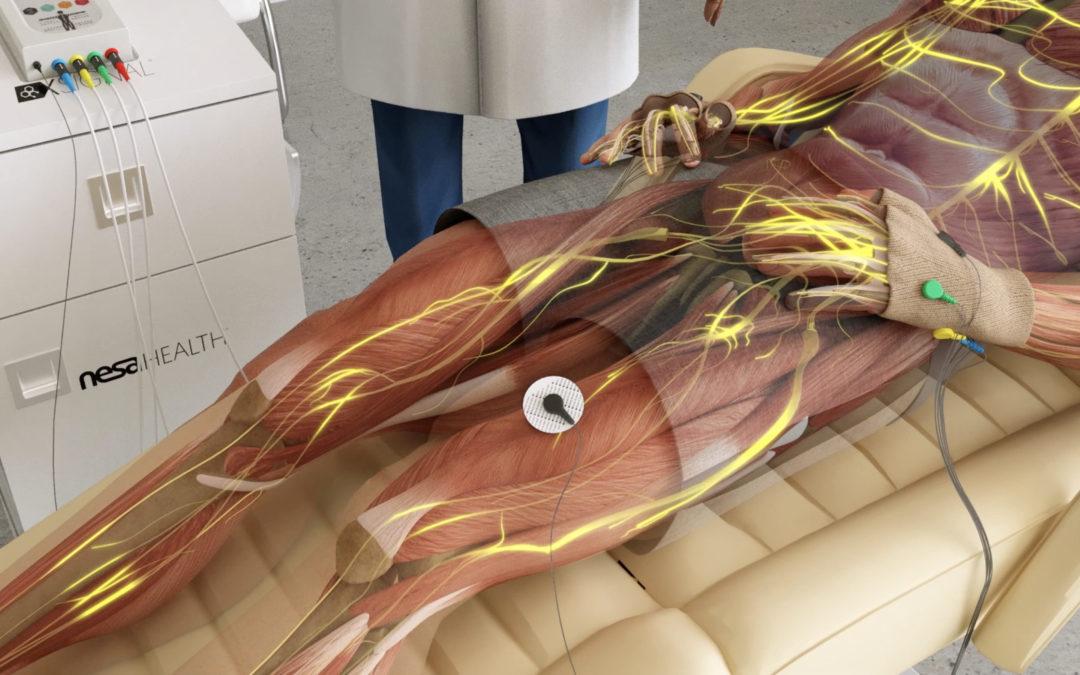 Electroterapia Neuromodulación NESA®